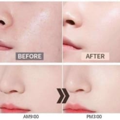 melasma cream có tác dụng gì